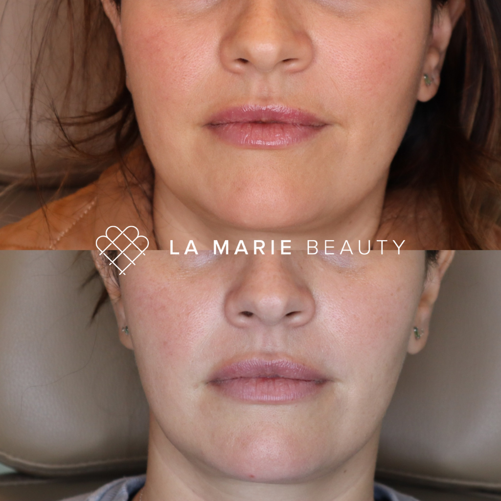 La Marie Beauty | Kybella