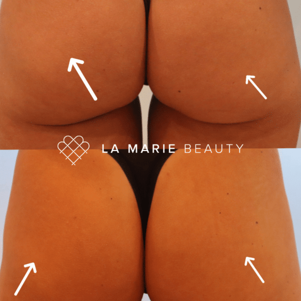 Sculptra Butt Lift - Image 2